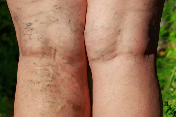 Vein Removal Treatment