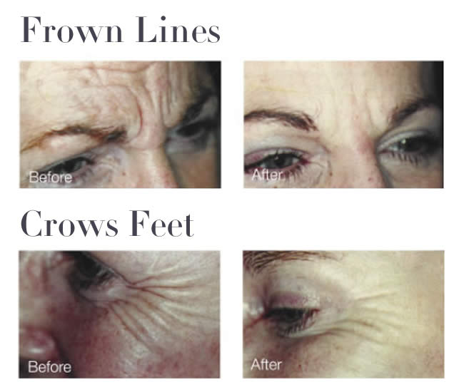 Wrinkle Injection Before & After