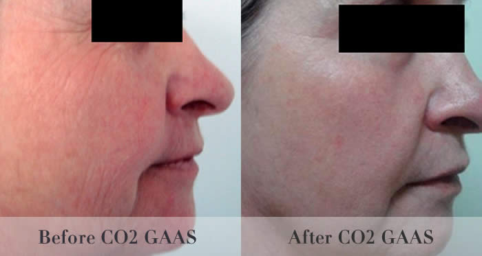 laser skin resurfacing before and after