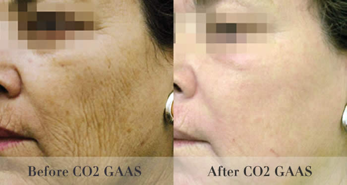 laser skin resurfacing before and after
