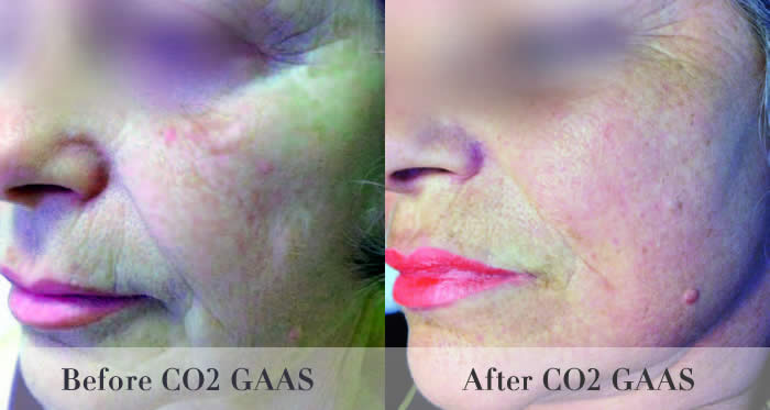 laser skin resurfacing before and after