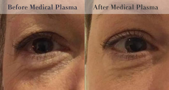 eye bag removal before and after