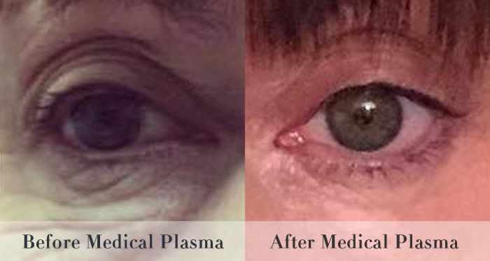 eye bag removal before and after