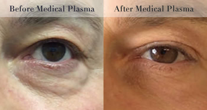 eye bag removal before and after