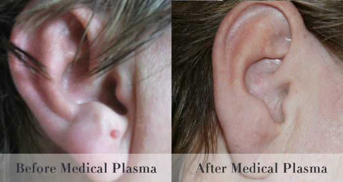 skin tag wart removal before and after