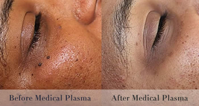 skin tag wart removal before and after