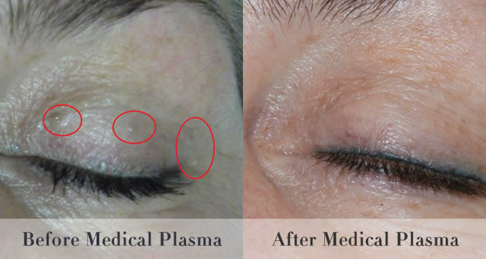 skin tag wart removal before and after