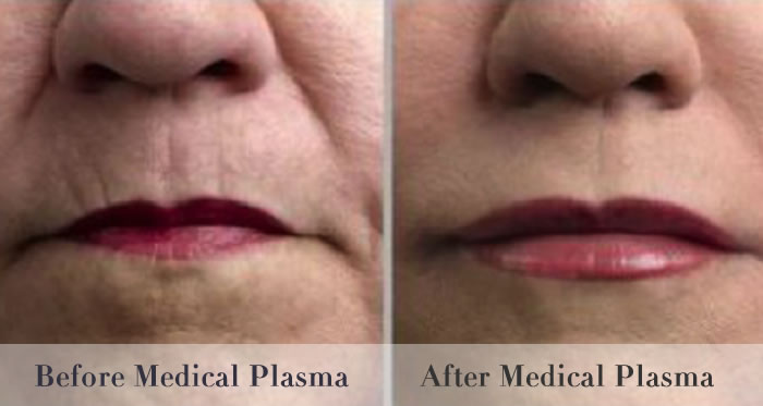 smokers-lines-before-and-after